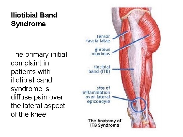 Iliotibial Band Syndrome The primary initial complaint in patients with iliotibial band syndrome is