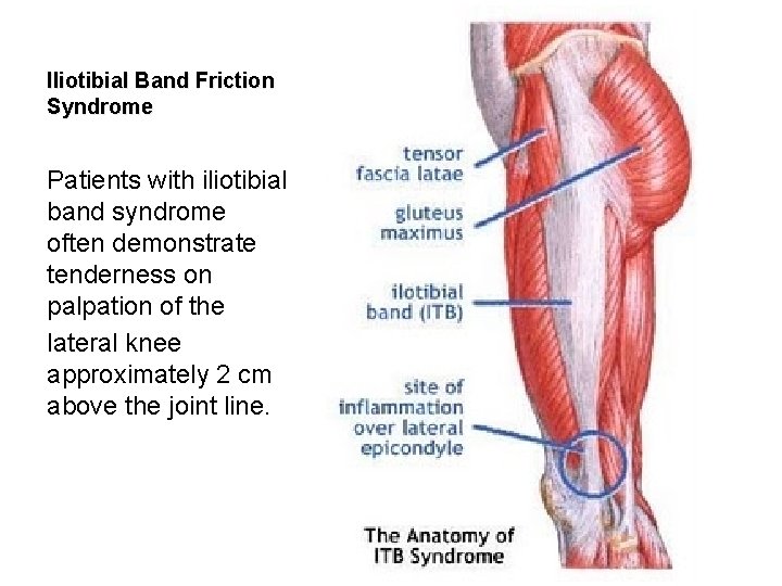 Iliotibial Band Friction Syndrome Patients with iliotibial band syndrome often demonstrate tenderness on palpation