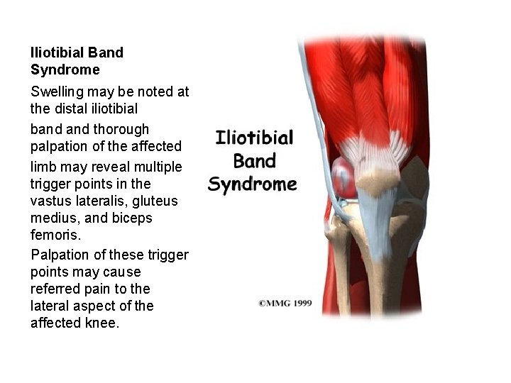 Iliotibial Band Syndrome Swelling may be noted at the distal iliotibial band thorough palpation