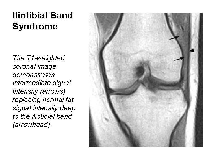 Iliotibial Band Syndrome The T 1 -weighted coronal image demonstrates intermediate signal intensity (arrows)