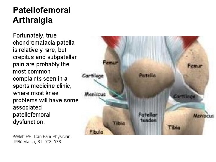 Patellofemoral Arthralgia Fortunately, true chondromalacia patella is relatively rare, but crepitus and subpatellar pain