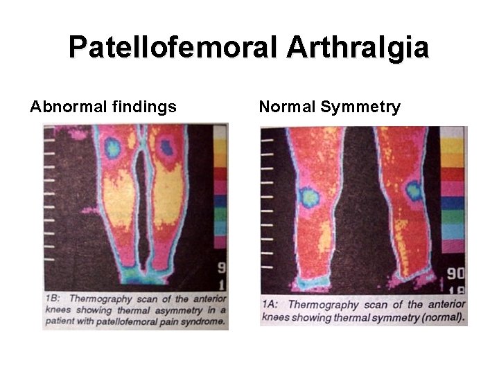 Patellofemoral Arthralgia Abnormal findings Normal Symmetry 