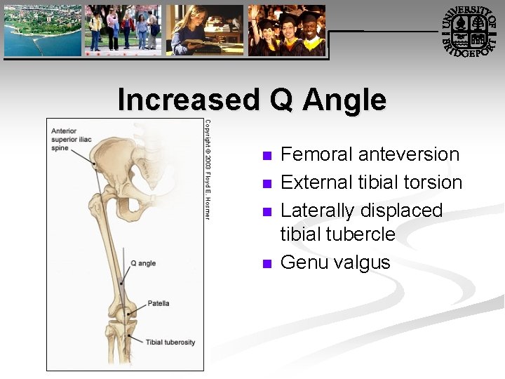 Increased Q Angle n n Femoral anteversion External tibial torsion Laterally displaced tibial tubercle