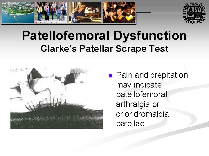 Patellofemoral Dysfunction Clarke’s Patellar Scrape Test n Pain and crepitation may indicate patellofemoral arthralgia