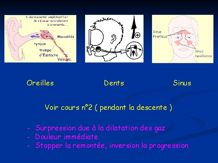 Oreilles Dents Sinus Voir cours n° 2 ( pendant la descente ) - Surpression Oreilles Dents Sinus Voir cours n° 2 ( pendant la descente ) - Surpression