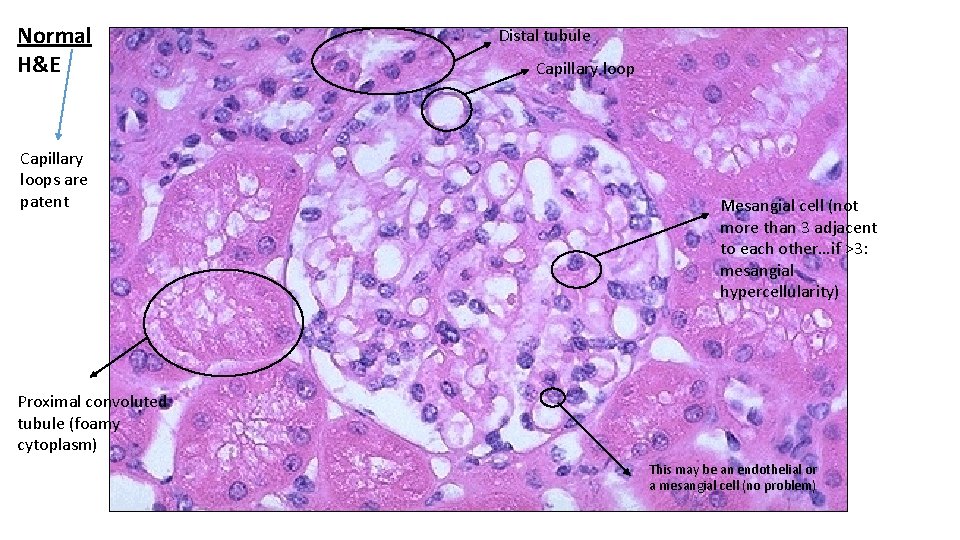 Normal H&E Capillary loops are patent Distal tubule Capillary loop Mesangial cell (not more