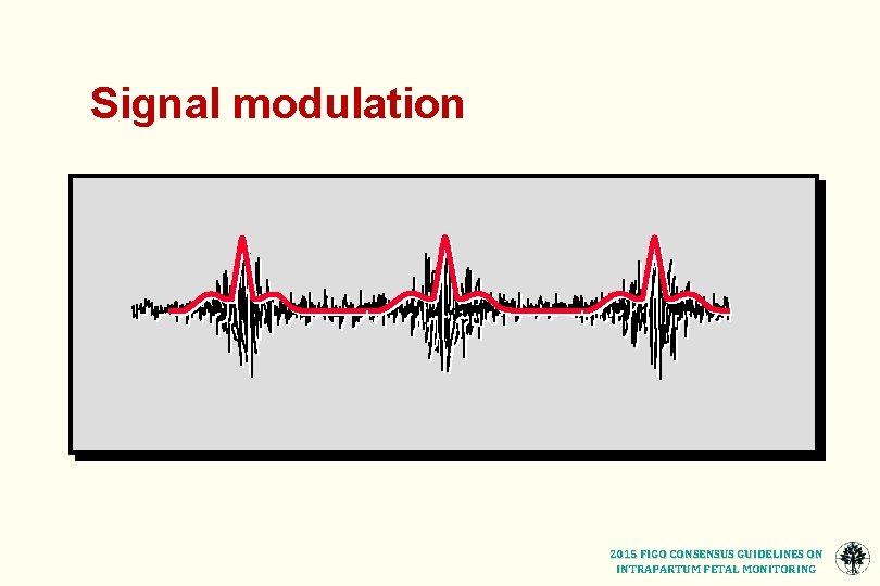 Signal modulation 2015 FIGO CONSENSUS GUIDELINES ON INTRAPARTUM FETAL MONITORING 