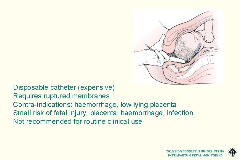 Disposable catheter (expensive) Requires ruptured membranes Contra-indications: haemorrhage, low lying placenta Small risk of