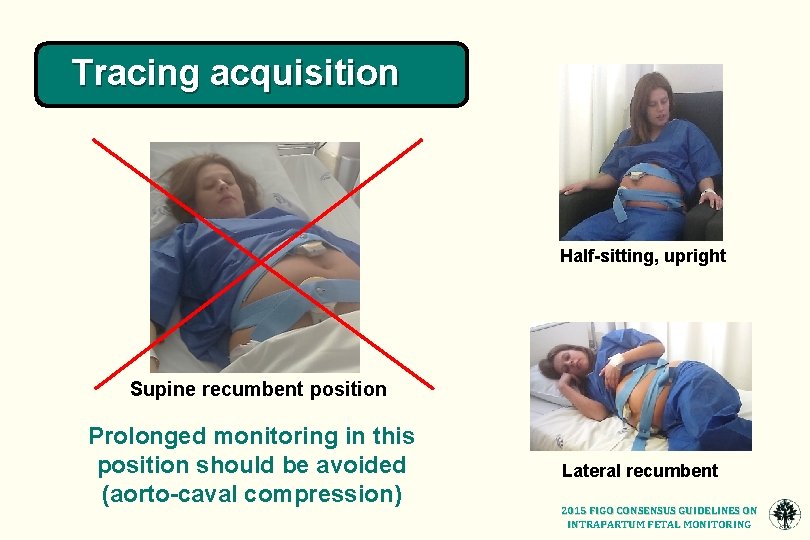 Tracing acquisition Half-sitting, upright Supine recumbent position Prolonged monitoring in this position should be
