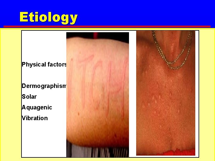 Etiology Physical factors Dermographism Solar Aquagenic Vibration 