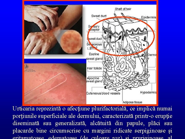 Urticaria reprezintă o afecţiune plurifactorială, ce implică numai porţiunile superficiale dermului, caracterizată printr-o erupţie