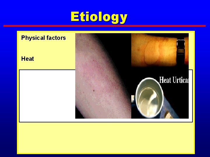 Etiology Physical factors Heat 