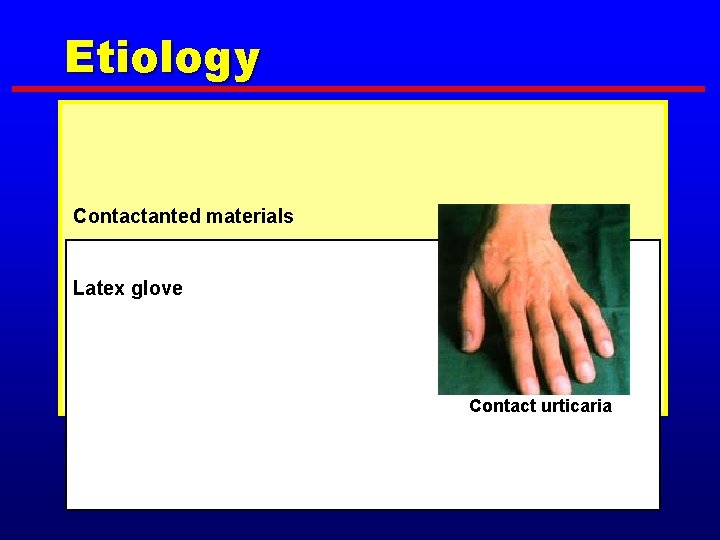 Etiology Contactanted materials Latex glove Contact urticaria 