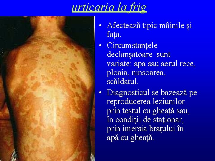 urticaria la frig • Afectează tipic mâinile și fața. • Circumstanțele declanșatoare sunt variate: