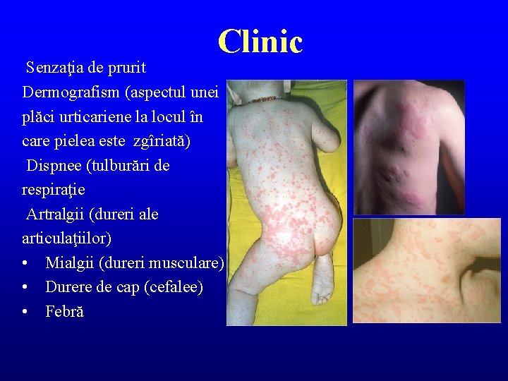 Clinic Senzaţia de prurit Dermografism (aspectul unei plăci urticariene la locul în care pielea