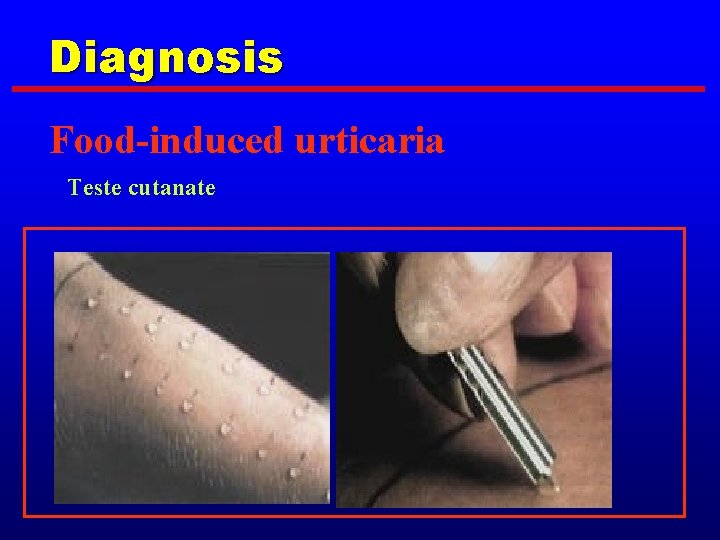 Diagnosis Food-induced urticaria Teste cutanate 