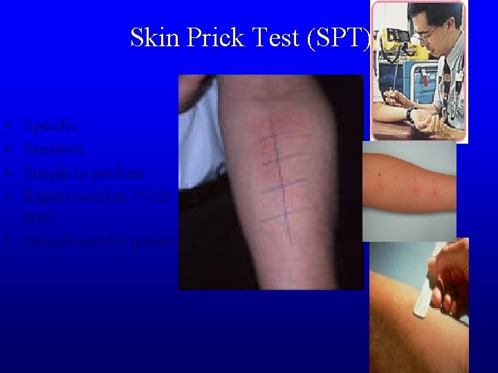 Skin Prick Test (SPT) • • Specific Sensitive Simple to perform Rapid (result in
