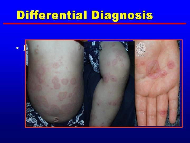 Differential Diagnosis • Erythema multiforme, minor 