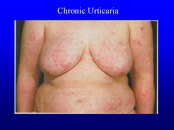 Chronic Urticaria 