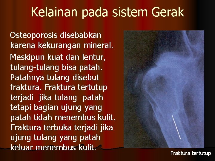 Kelainan pada sistem Gerak Osteoporosis disebabkan karena kekurangan mineral. Meskipun kuat dan lentur, tulang-tulang