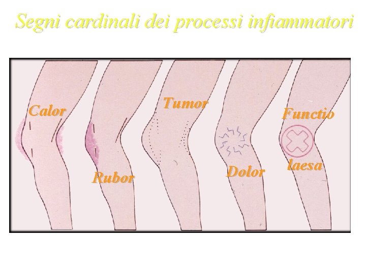 Segni cardinali dei processi infiammatori Tumor Calor Rubor Functio Dolor laesa Galeno 129 -201