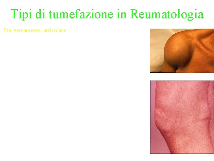 Tipi di tumefazione in Reumatologia Da versamento articolare: è causata da un aumento del