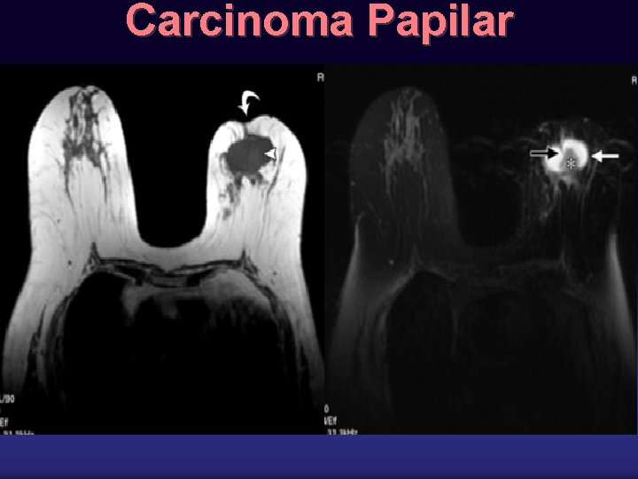 Carcinoma Papilar 