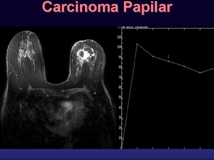 Carcinoma Papilar 