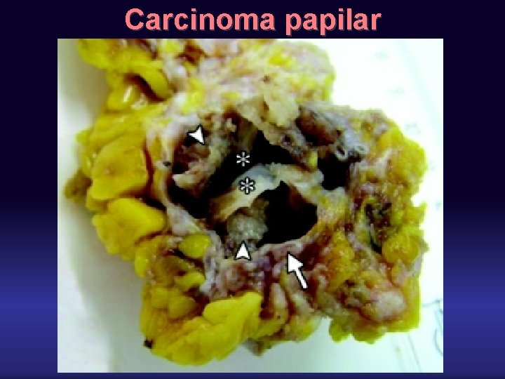 Carcinoma papilar 