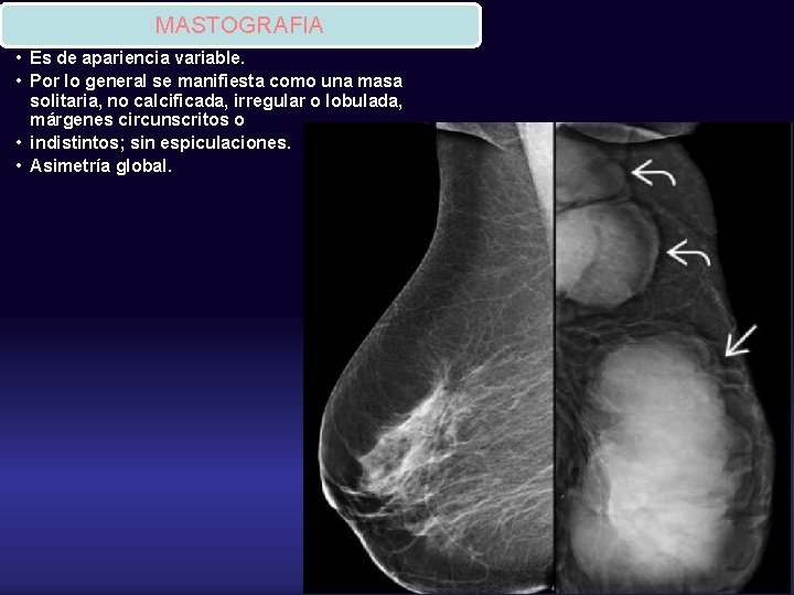 MASTOGRAFIA • Es de apariencia variable. • Por lo general se manifiesta como una