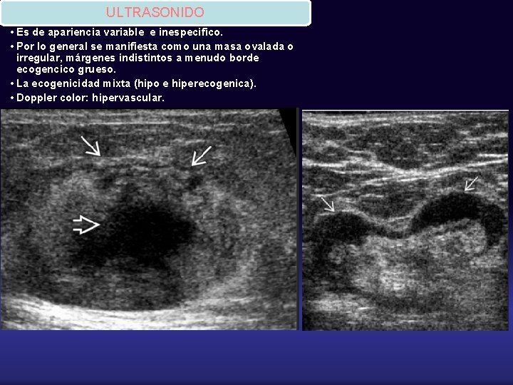 ULTRASONIDO • Es de apariencia variable e inespecifico. • Por lo general se manifiesta