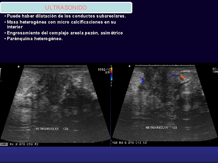 ULTRASONIDO • Puede haber dilatación de los conductos subareolares. • Masa heterogénea con micro