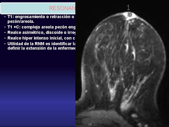 RESONANCIA • T 1: engrosamiento o retracción o inversión de la región del pezón/areola.