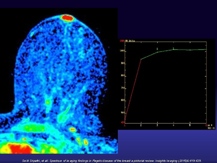 Smiti Sripathi, et all. Spectrum of imaging findings in Pagets disease of the breast