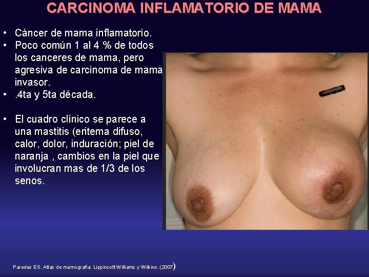 CARCINOMA INFLAMATORIO DE MAMA • Cáncer de mama inflamatorio. • Poco común 1 al
