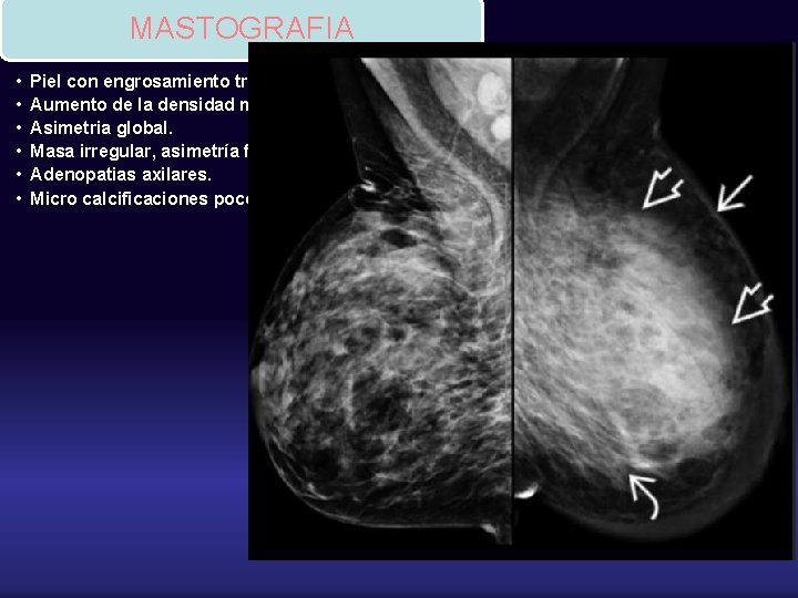 MASTOGRAFIA • • • Piel con engrosamiento trabecular. Aumento de la densidad mamaria de