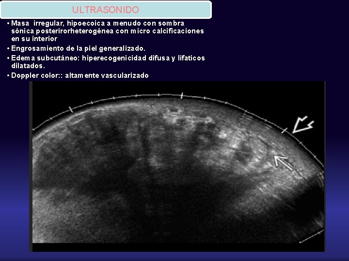 ULTRASONIDO • Masa irregular, hipoecoica a menudo con sombra sónica posterirorheterogénea con micro calcificaciones