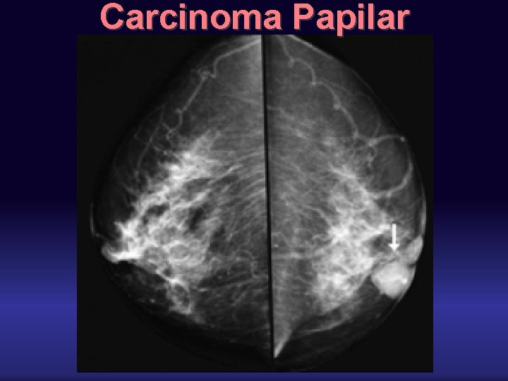 Carcinoma Papilar 