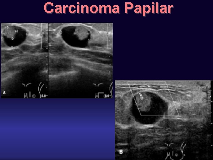 Carcinoma Papilar 