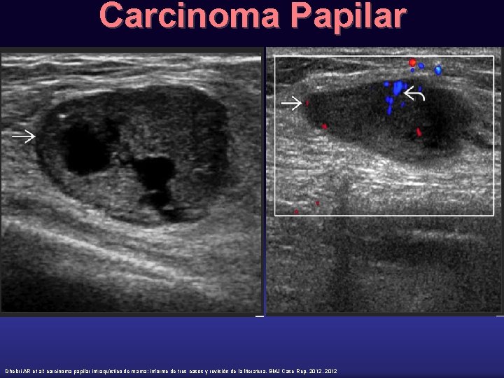 Carcinoma Papilar Dhebri AR et al: carcinoma papilar intraquístico de mama: informe de tres