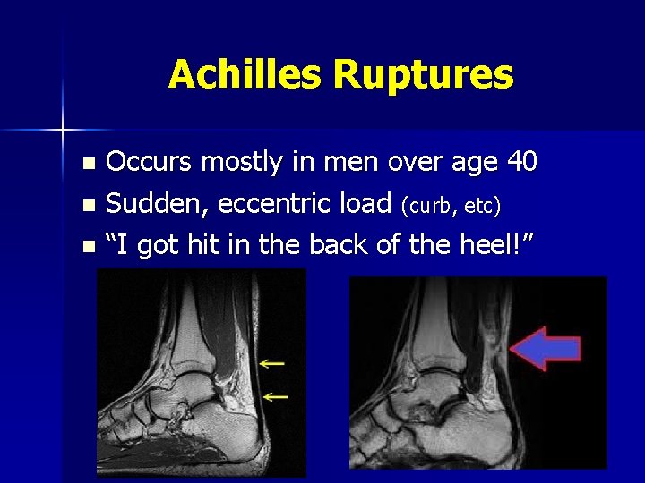 Achilles Ruptures Occurs mostly in men over age 40 n Sudden, eccentric load (curb,