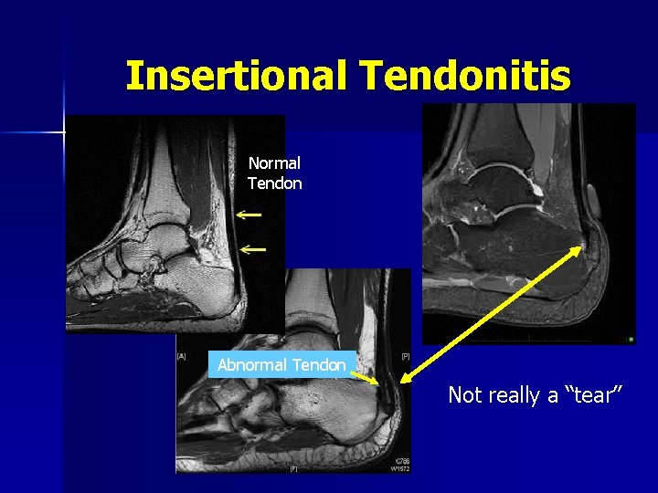Insertional Tendonitis Normal Tendon Abnormal Tendon Not really a “tear” 