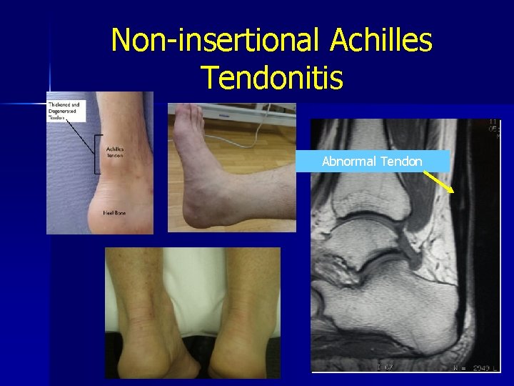 Non-insertional Achilles Tendonitis Abnormal Tendon 