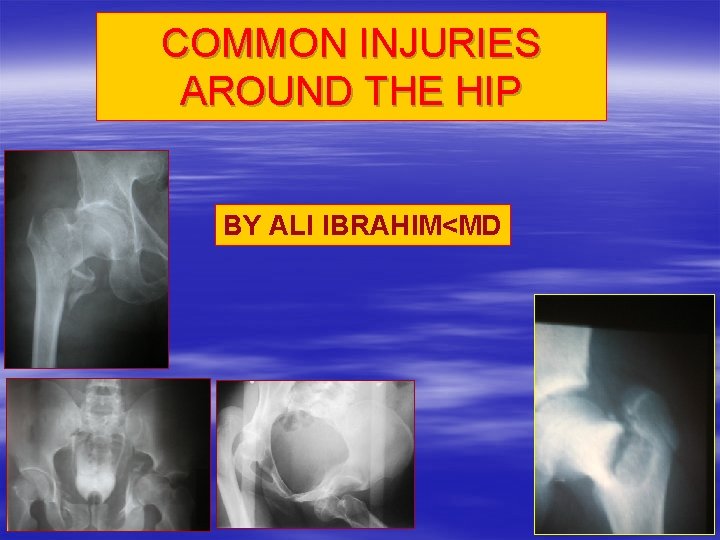 COMMON INJURIES AROUND THE HIP BY ALI IBRAHIM<MD 