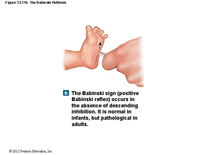 Figure 13 -21 b The Babinski Reflexes The Babinski sign (positive Babinski reflex) occurs