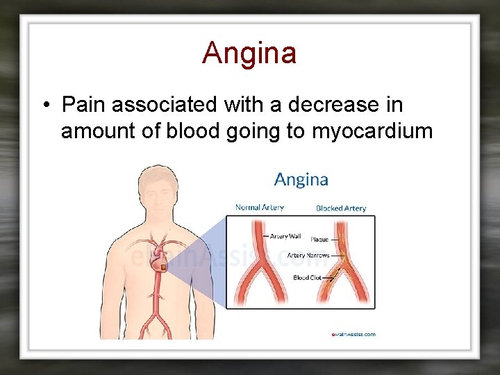 Angina • Pain associated with a decrease in amount of blood going to myocardium