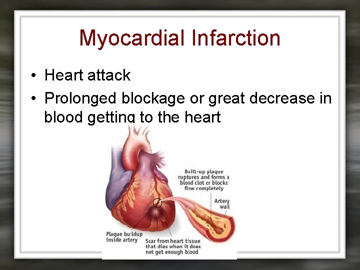 Myocardial Infarction • Heart attack • Prolonged blockage or great decrease in blood getting