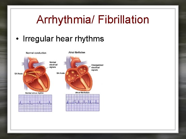 Arrhythmia/ Fibrillation • Irregular hear rhythms 