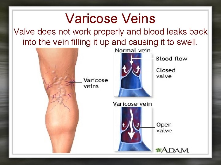 Varicose Veins Valve does not work properly and blood leaks back into the vein