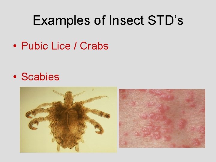 Examples of Insect STD’s • Pubic Lice / Crabs • Scabies 